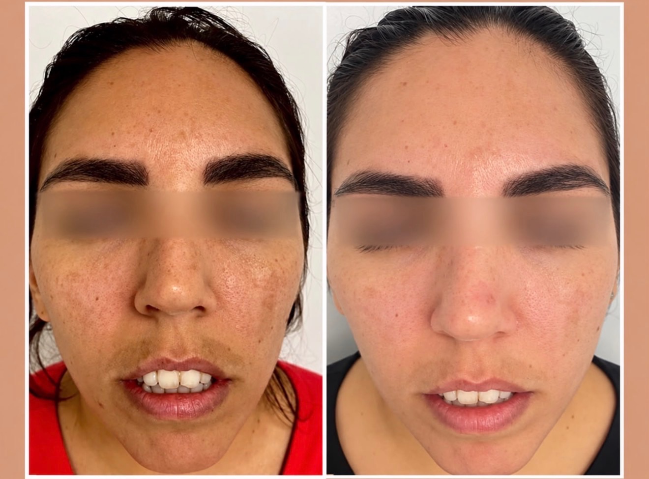 Chemical peel — before treatment